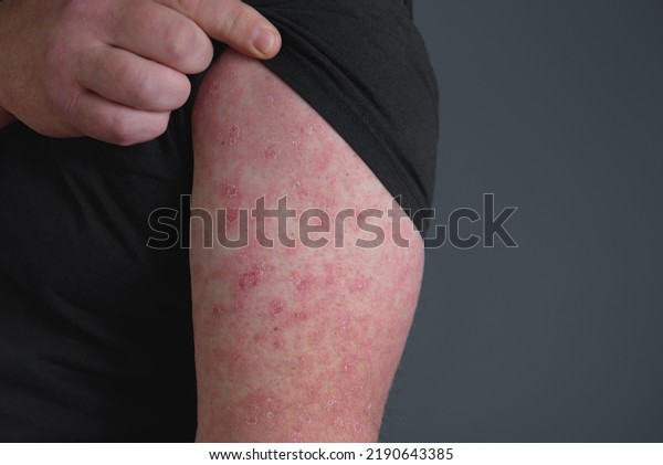 Red rash on forearm. Hand afflicted\
Ð²ermatophytosis on skin.\
Erysipelas