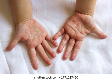 Red Rash On The Hands Of The Palms Of The Child, Rubella Scarlet Fever Coxsackie And Other Infectious Viral Diseases In Children And Adults