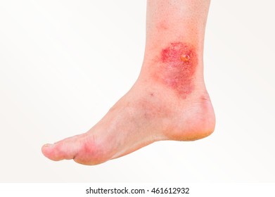 Red Rash On Leg Patient Who Stock Photo (Edit Now) 461612932