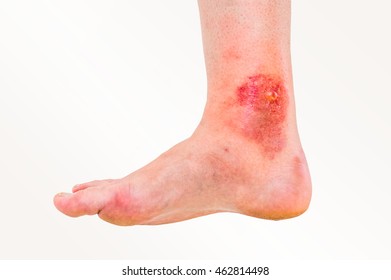 Red Rash On Leg Patient Who Stock Photo (Edit Now) 461612932