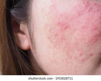 Red Rash On Young Asian Thai Woman Face, Itchy And Allergic Skin Problems, Dermatitis.