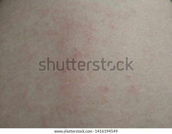 caustic soda burn remedy