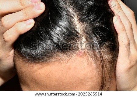 red scaly scalp  is psoriasis  Caused by stress, annoyance, itching sensation  incurable