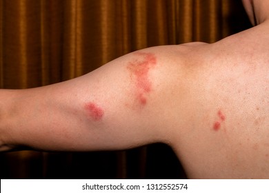 Red Spot Inflammation Skin Cause By Stock Photo (Edit Now) 1312552574