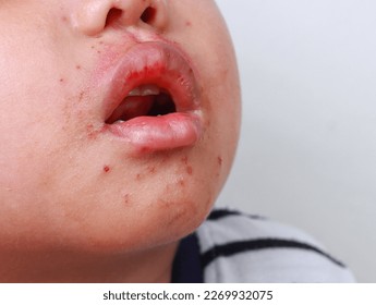 Red spot on mouth Hand foot and mouth disease of kid Herpangina disease HFMD  of infection skin disease sickness rash skin - Shutterstock ID 2269932075