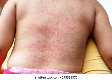 Red spots on baby's skin due to Dengue virus (Dengue hemorrhagic fever)