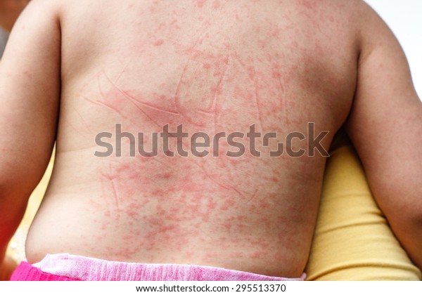 Red spots on baby's skin due to Dengue virus
(Dengue hemorrhagic fever)