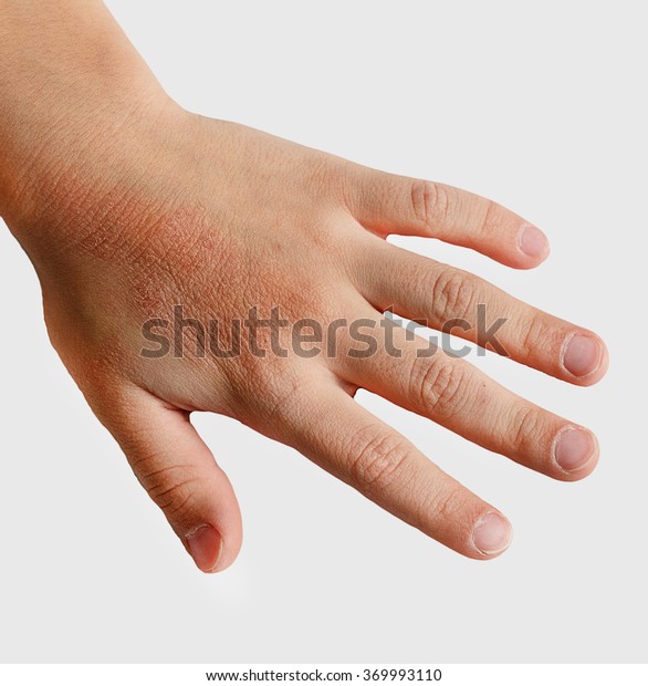 red-spots-on-child-hands-skin-stock-photo-369993110-shutterstock