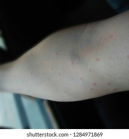 Red Spots On Skin Arm Due Stock Photo 1284971869 | Shutterstock