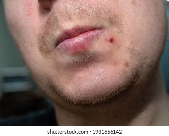 Red Stubble On A Man's Face And Pimples On His Face. Skin Problems On The Face
