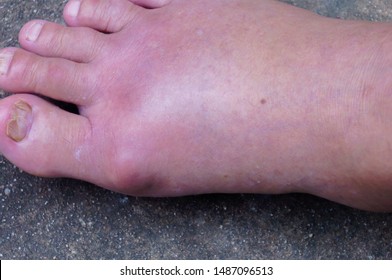 Gout Images, Stock Photos & Vectors | Shutterstock