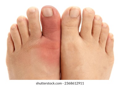 Red and swollen gouty big toe