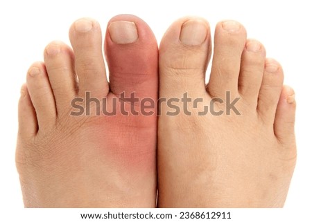 Red and swollen gouty big toe