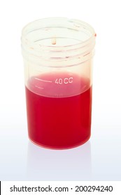 Red Urine, Hematuria Urine Medical Analysis 