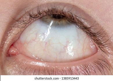 Red Veins In The Eye Of A Boy, Macro .