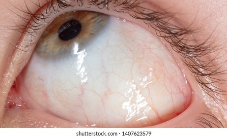 Red Veins In The Eye Of A Boy, Macro .