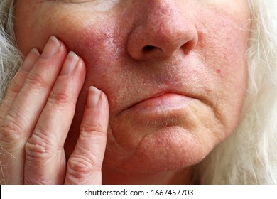 Red Veins, Spots And Operation Scars On The Face Of An Older Woman