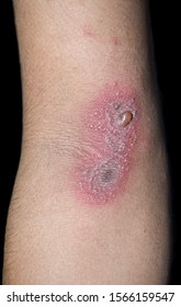 Reddened Patch Vesicles Blister On Elbow Foto stock 1566159547 ...