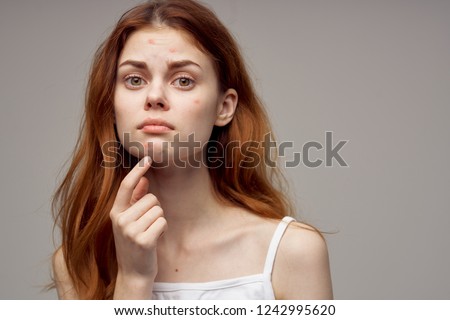 redheaded woman shows fingers on acne on her face                        