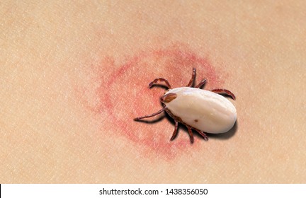 Redness Of Tick Bite, Macro Image