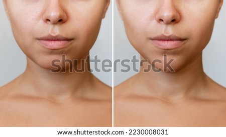 Сhin reduction with fillers. Woman's face with jaws and chin before and after mentoplasty isolated on a gray background. The result of cosmetic plastic surgery. Beauty concept