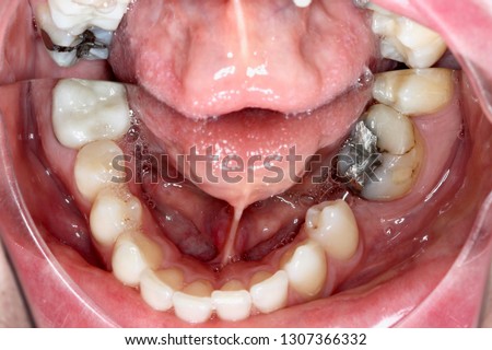 Reflected Oral Cavity