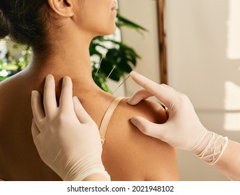 Reflexologist hand with acupuncture needle close-up during insert needle into a woman's shoulder for treatment. Acupuncture, reflexology