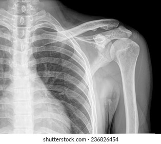 Shoulder Xray Images Stock Photos Vectors Shutterstock