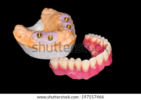 Removable denture and gypsum model on isolated black background
