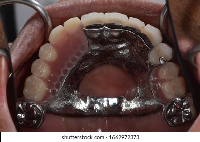 The Removable Partial Dentures And Crowns