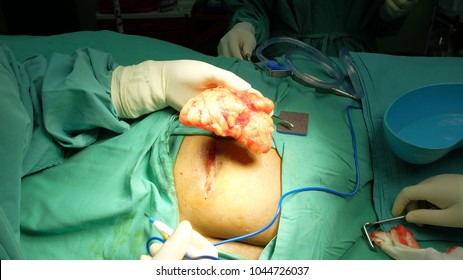  Removal Of Huge Lipoma Of The Gluteal Region 