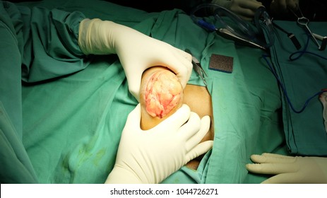  Removal Of Huge Lipoma Of The Gluteal Region 