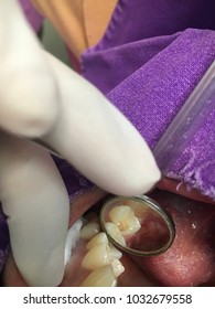 removing detal caries then indirect pulp capping