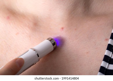 Removing A Red Pimple On A Girl's Neck With A Cosmetic Laser Pen, Macro