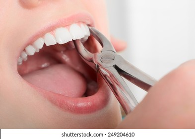 Entfernen des kranken Zahns aus dem Mund der Mädchen