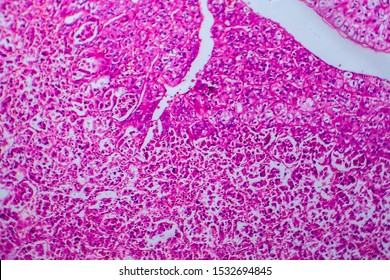 Renal Cell Carcinoma, Light Micrograph, Photo Under Microscope