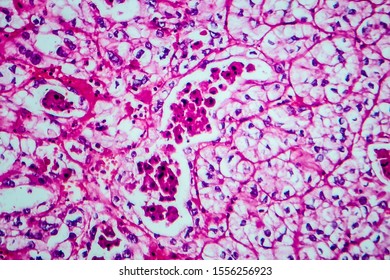 Renal Cell Carcinoma, Light Micrograph, Photo Under Microscope