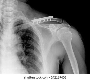 Rengs Snapshot Of The Shoulder Joint With A Bolt , Xray