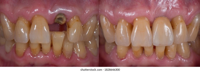 Replacing Missing Tooth With Dental Implant, Implant Supported Crown, Before And After.