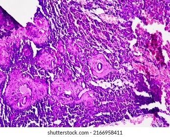 Resected Lower Part Of Stomach(biopsy): Lymph Node Show Reactive Change, Gastric Biopsies,Stomach Cancer. Histology Testing