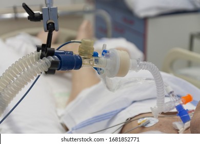 Respiratory connection tube, HME filter and suction catheter, patient connected to medical ventilator in ICU in hospital. 