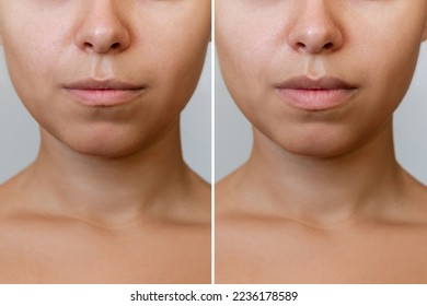 Resultado del aumento de labios. Toma recortada de la parte inferior de la cara de la joven con los labios antes y después de realzar los labios sobre un fondo gris. Inyección del relleno en los labios