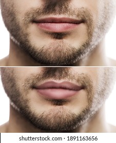 Result Of Lip Augmentation. Male Lips  Before And After Filler Injection.