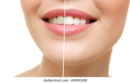 Result Of Teeth Whitening. Smiling Young Woman On White Background, Closeup