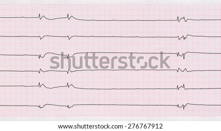 Resuscitation and intensive care. ECG with single ventricular complexes and ventricular asystole (