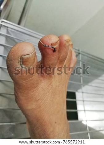 retain fish hook at 2nd toe right foot, emergency room