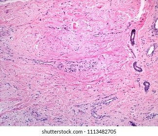 The Reticular Dermis Is A Dense Irregular Connective Tissue With Densely Packed Collagen Fibers. It Shows Blood Vessels, Nerve Fibers, And, On The Left Side, A Sweat Gland Duct.