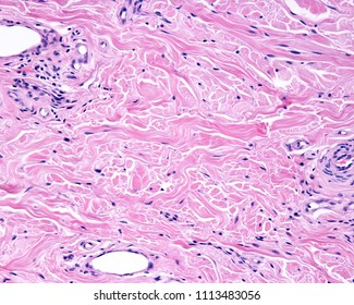 The Reticular Dermis Is A Dense Irregular Connective Tissue With Densely Packed Collagen Fibers, Forming Intertwined Fascicles. On The Borders Of The Image There Are Blood Vessels And Nerve Fibers.