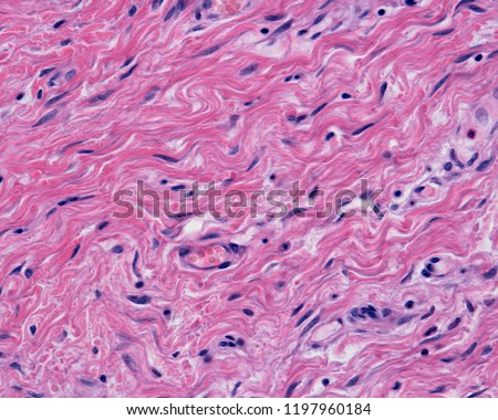 The reticular dermis is a dense irregular connective tissue with densely packed collagen fibers. Some small blood vessels can also be seen .