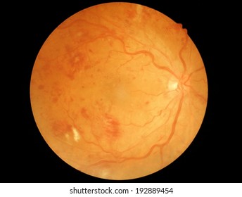 Retina Of Diabetic - Diabetes Retinopathy